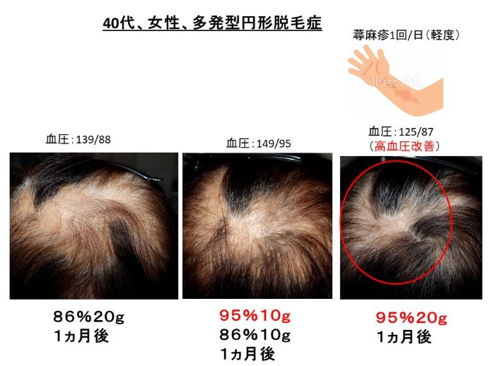 円形脱毛症　病院